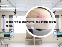 廊坊青少年银屑病怎样治 青少年银屑病可以根治吗