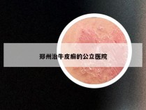 郑州治牛皮癣的公立医院