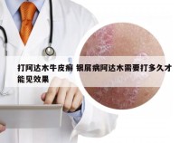 打阿达木牛皮癣 银屑病阿达木需要打多久才能见效果