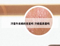 汗是牛皮癣的克星吗 汗癣是真菌吗
