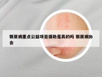 银屑病重点公益项目援助是真的吗 银屑病协会