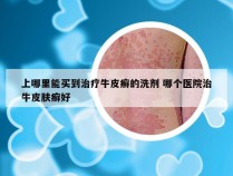 上哪里能买到治疗牛皮癣的洗剂 哪个医院治牛皮肤癣好