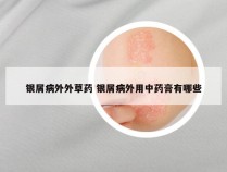 银屑病外外草药 银屑病外用中药膏有哪些