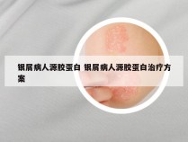 银屑病人源胶蛋白 银屑病人源胶蛋白治疗方案