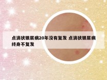 点滴状银屑病20年没有复发 点滴状银屑病终身不复发