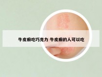 牛皮癣吃巧克力 牛皮癣的人可以吃