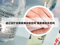 通过治疗会银屑病会痊愈吗 银屑病会攻克吗