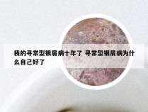 我的寻常型银屑病十年了 寻常型银屑病为什么自己好了