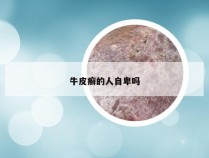牛皮癣的人自卑吗