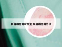银屑病检测试剂盒 银屑病检测方法