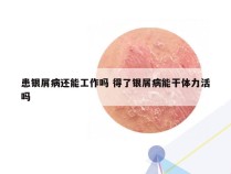 患银屑病还能工作吗 得了银屑病能干体力活吗