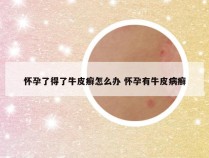 怀孕了得了牛皮癣怎么办 怀孕有牛皮病癣