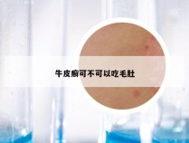 牛皮癣可不可以吃毛肚
