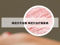 梅花针牛皮癣 梅花针治疗银屑病