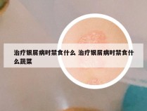 治疗银屑病时禁食什么 治疗银屑病时禁食什么蔬菜