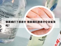 银屑病打了激素针 银屑病打激素针它会复发吗?