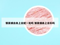 银屑病会身上会就一处吗 银屑病身上会长吗