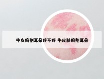 牛皮癣割耳朵疼不疼 牛皮肤癣割耳朵