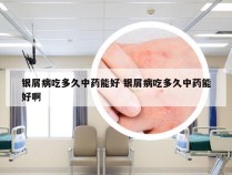 银屑病吃多久中药能好 银屑病吃多久中药能好啊