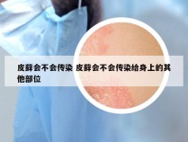 皮藓会不会传染 皮藓会不会传染给身上的其他部位