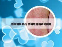德国银屑病药 德国银屑病药的图片