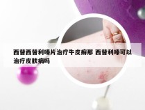 西替西替利嗪片治疗牛皮癣那 西替利嗪可以治疗皮肤病吗