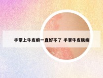 手掌上牛皮癣一直好不了 手掌牛皮肤癣
