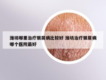 潍坊哪里治疗银屑病比较好 潍坊治疗银屑病哪个医院最好