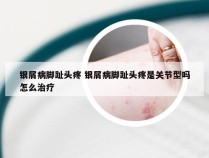 银屑病脚趾头疼 银屑病脚趾头疼是关节型吗怎么治疗