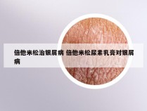 倍他米松治银屑病 倍他米松尿素乳膏对银屑病