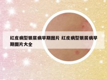 红皮病型银屑病早期图片 红皮病型银屑病早期图片大全