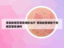掌跖脓疱型银屑病的治疗 掌跖脓疱病属于脓疱型银屑病吗