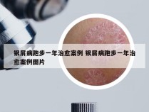 银屑病跑步一年治愈案例 银屑病跑步一年治愈案例图片