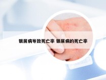 银屑病导致死亡率 银屑病的死亡率