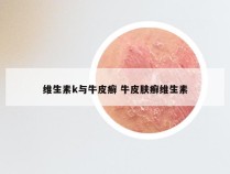 维生素k与牛皮癣 牛皮肤癣维生素