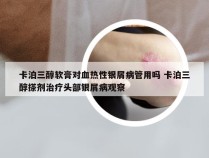 卡泊三醇软膏对血热性银屑病管用吗 卡泊三醇搽剂治疗头部银屑病观察