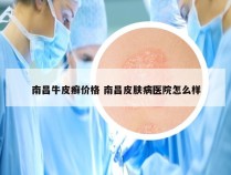 南昌牛皮癣价格 南昌皮肤病医院怎么样