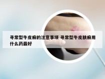 寻常型牛皮癣的注意事项 寻常型牛皮肤癣用什么药最好