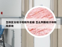 怎样区分蚊子咬和牛皮癣 怎么判断蚊子块和风疹块