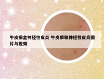牛皮癣盒神经性皮炎 牛皮廨和神经性皮炎图片与视频