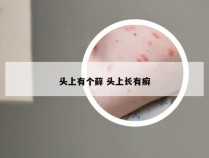 头上有个藓 头上长有癣