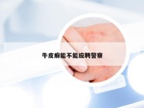 牛皮癣能不能应聘警察