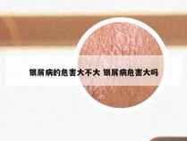银屑病的危害大不大 银屑病危害大吗