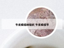 牛皮癣结缔组织 牛皮癣结节