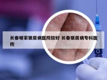 长春哪家银屑病医院较好 长春银屑病专科医院