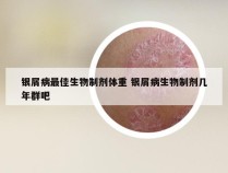 银屑病最佳生物制剂体重 银屑病生物制剂几年群吧