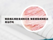 银屑病从褐色变成粉红色 银屑病变成褐色还用治疗吗