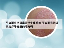平山那有泡温泉治疗牛皮癣的 平山那有泡温泉治疗牛皮癣的地方吗