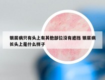 银屑病只有头上有其他部位没有遮挡 银屑病长头上是什么样子