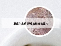 肝癌牛皮癣 肝癌皮肤症状图片